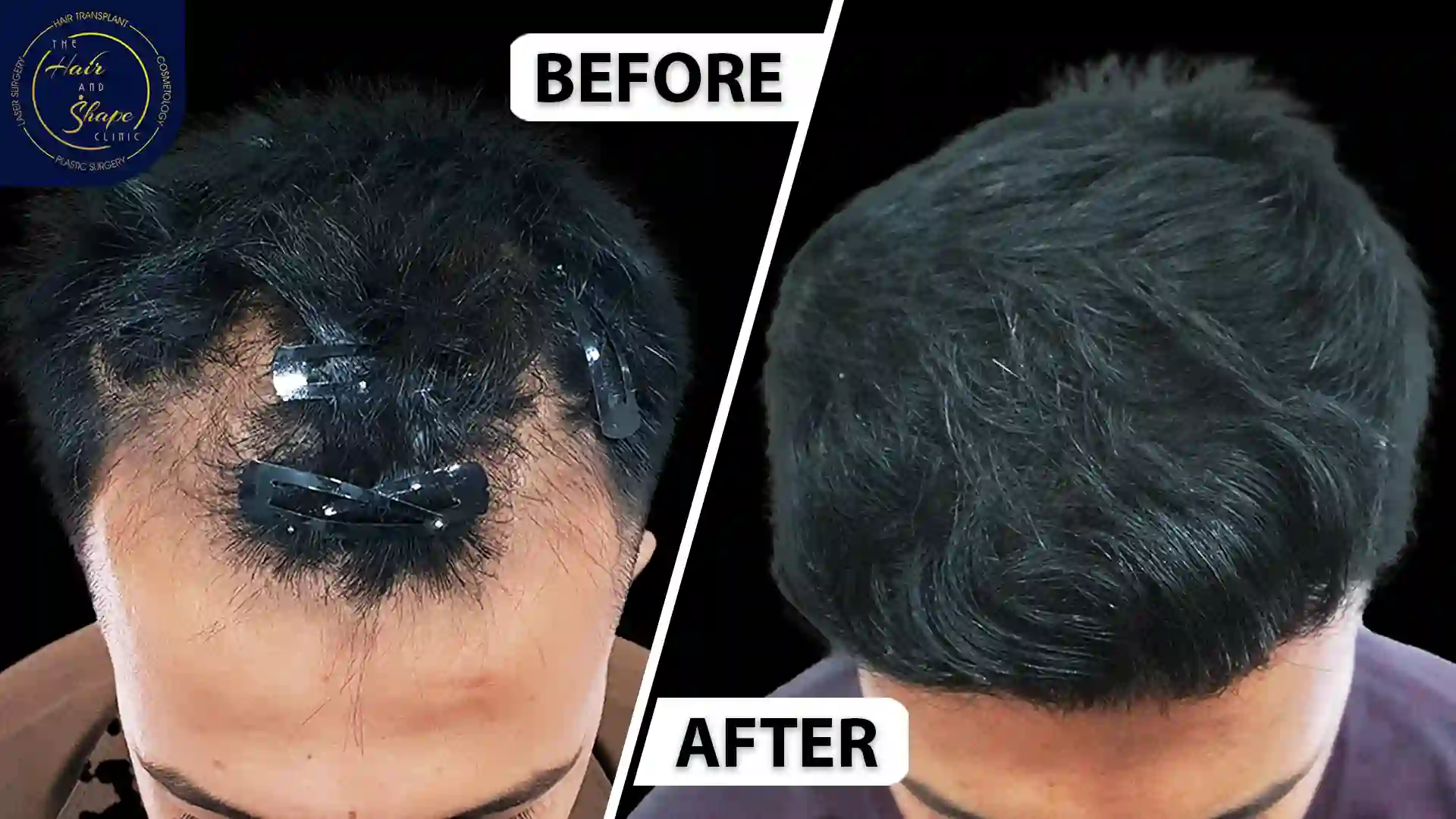 Hair Transplant result13